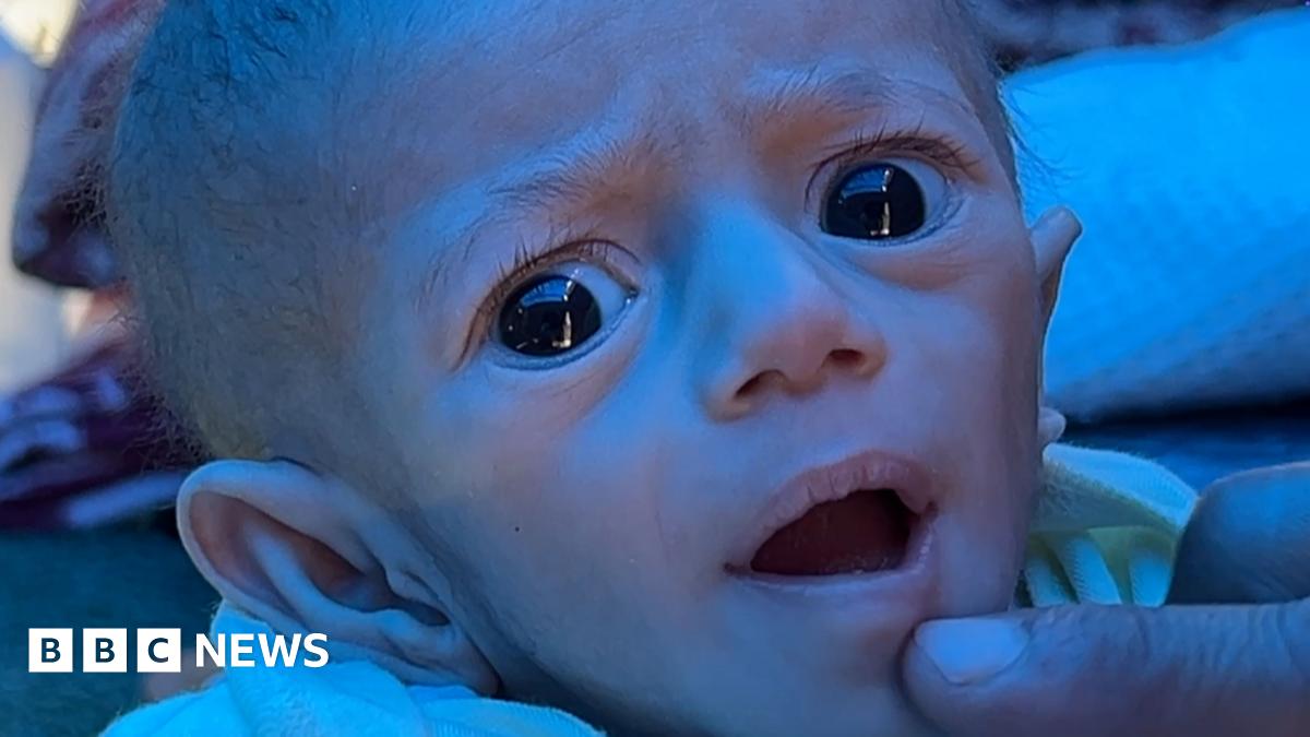 Hunger In Gaza: BBC Story Reveals Blockade's Devastating Effects Hunger In Gaza: BBC Story Reveals Blockade's Devastating Effects
